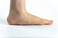 What Causes Adult-Onset Flat Feet?