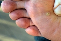 Treating Plantar Warts With Laser Treatment