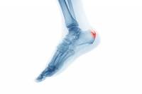 Treatment for Bone Spurs on the Feet